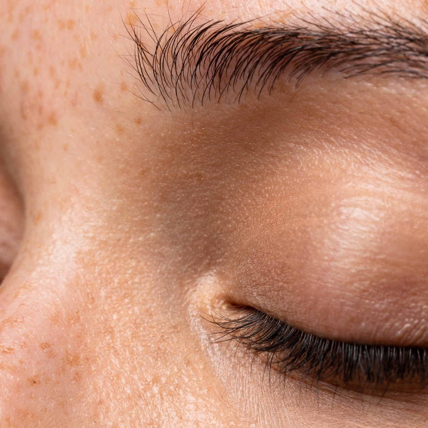 Restylane