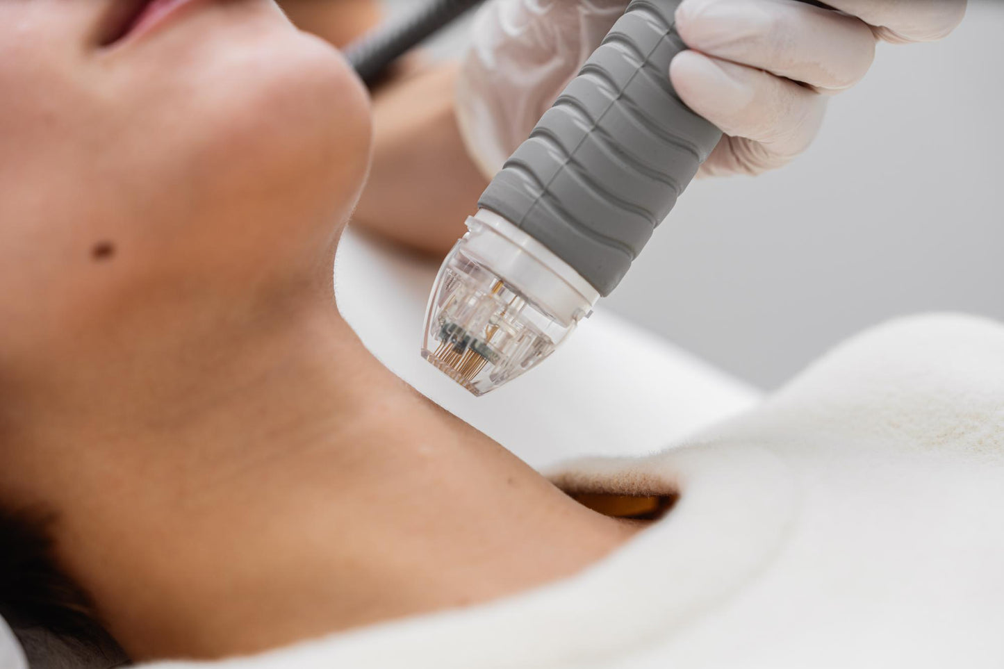 Microneedling (Face & Neck)